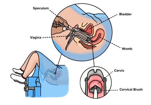 diagram of smear test
